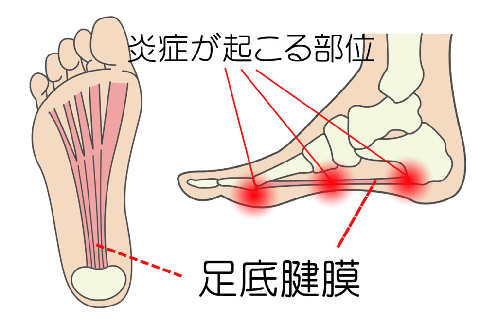 足底腱膜炎